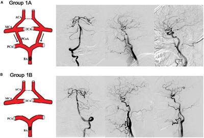 The Impact of Variational Primary Collaterals on Cerebral Autoregulation